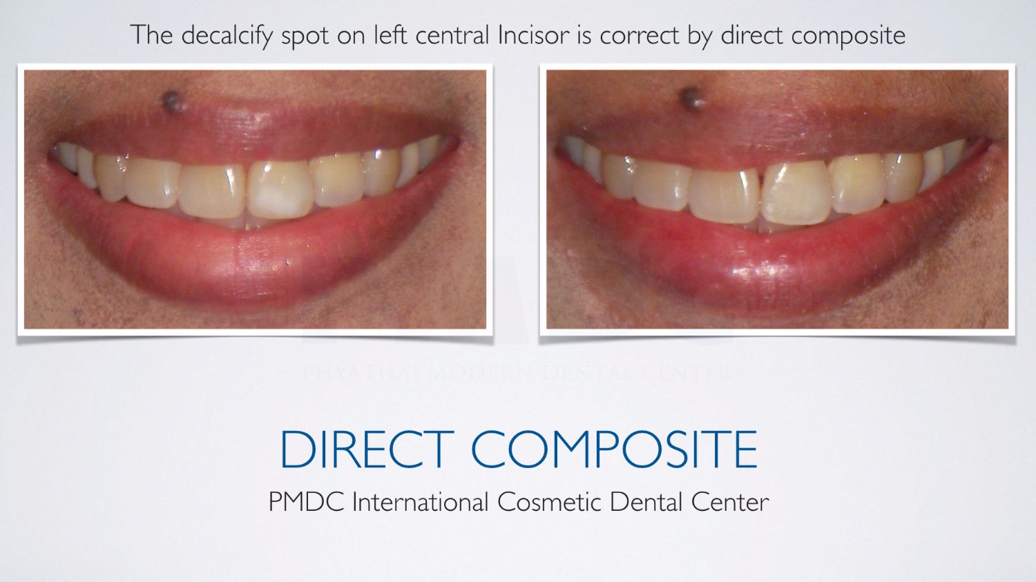 Direct Composite | PMDC Dental